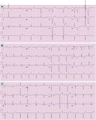 Case report: Metastatic melanoma masquerading as apical hypertrophic cardiomyopathy